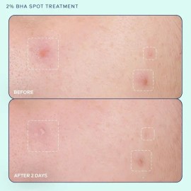 Skinfix Acne+ 2% Bha Tratamiento De Manchas Para El Acné: Tr