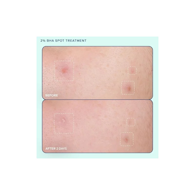 Skinfix Acne+ 2% Bha Tratamiento De Manchas Para El Acné: