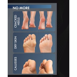 Exfoliating foot peel mask for hard skin, feet peeling socks, baby feet foot peel, foot exfoliant, foot treatment for hard skin, dermatologically tested, 1 pair (up to size 12)