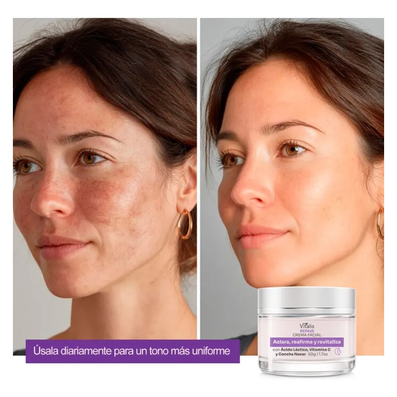 Crema Despigmentante Para Manchas, Melasma, Acné Y Paño 50g
