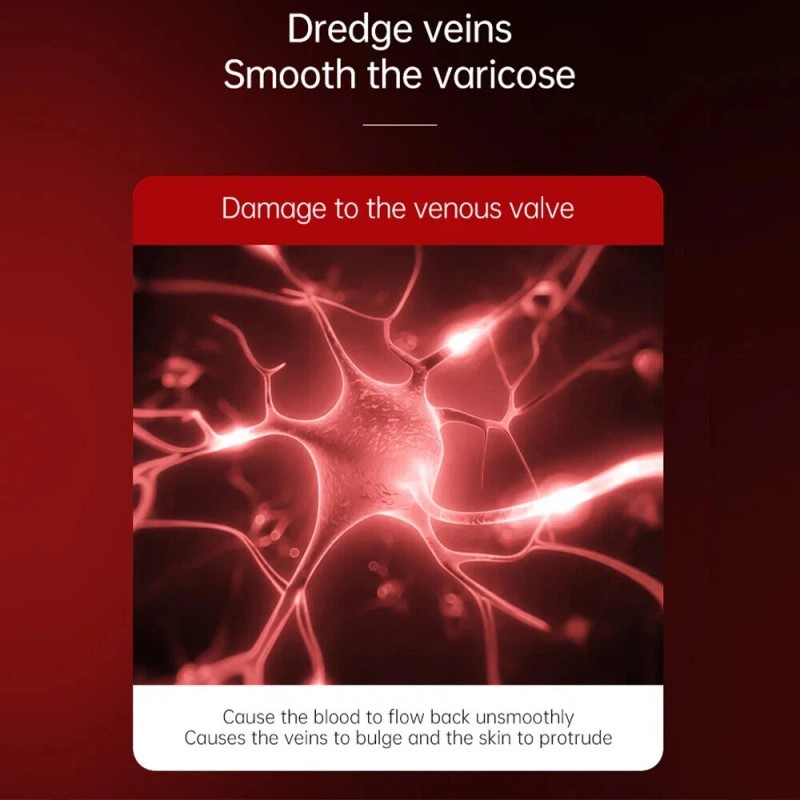 Varicose Veins Relief