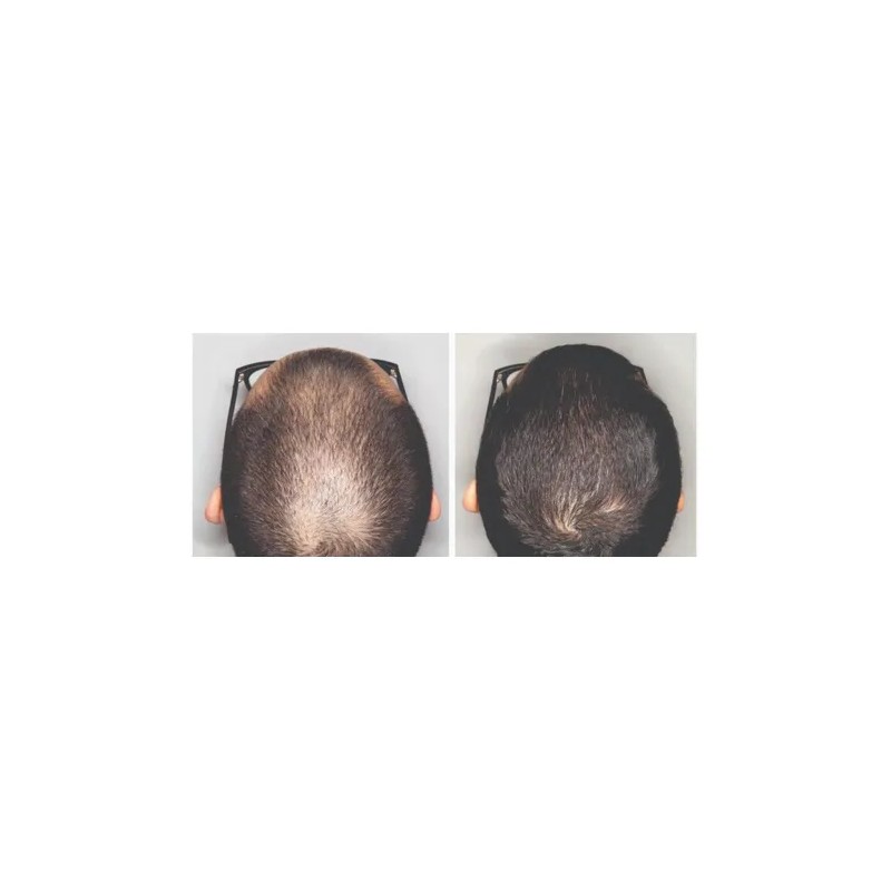Tratamiento Anticaída De Cabello Al 15% Dth Blocker 6 Meses