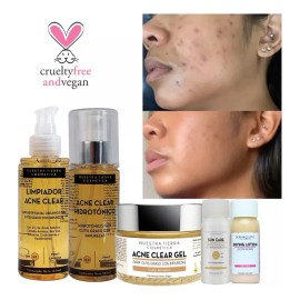 Kit Anti-acné Orgánico Shampoo, Tónico, Gel Y Loción Secante