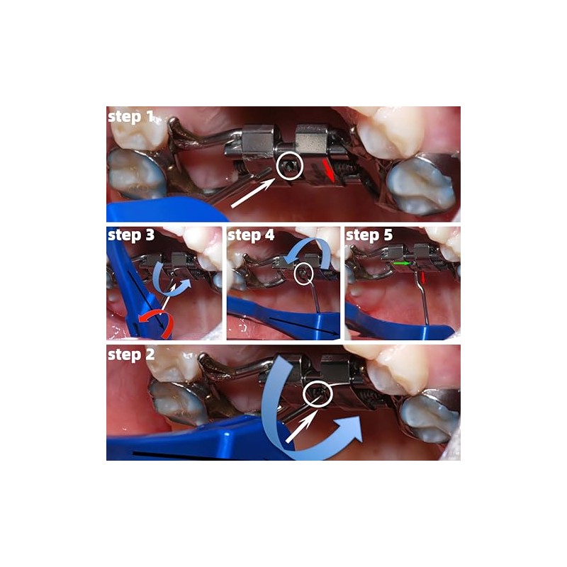 Llave expansora: herramienta giratoria de expansión de ortodoncia dental para