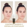 Crema Anti Acné Control Grasa Reduce Manchas Life Tipo Piel
