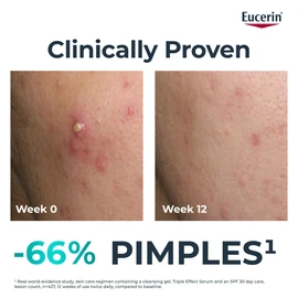 Eucerin Dermopure Clinical Triple Action Fluid 40ml, Face Serum with Salicylic Acid & Thiamidol, Imperfection and Acne Treatment, Exfoliator for Blemish-Prone Skin