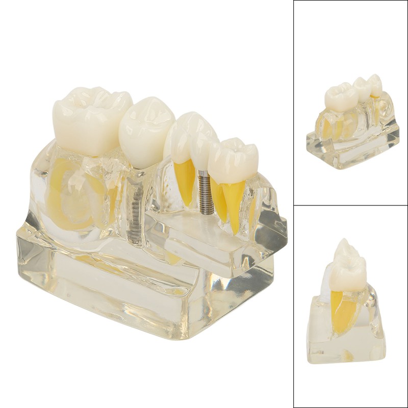 Teeth Implant Model Transparent Dental Teaching Research Demonstration Teeth Model