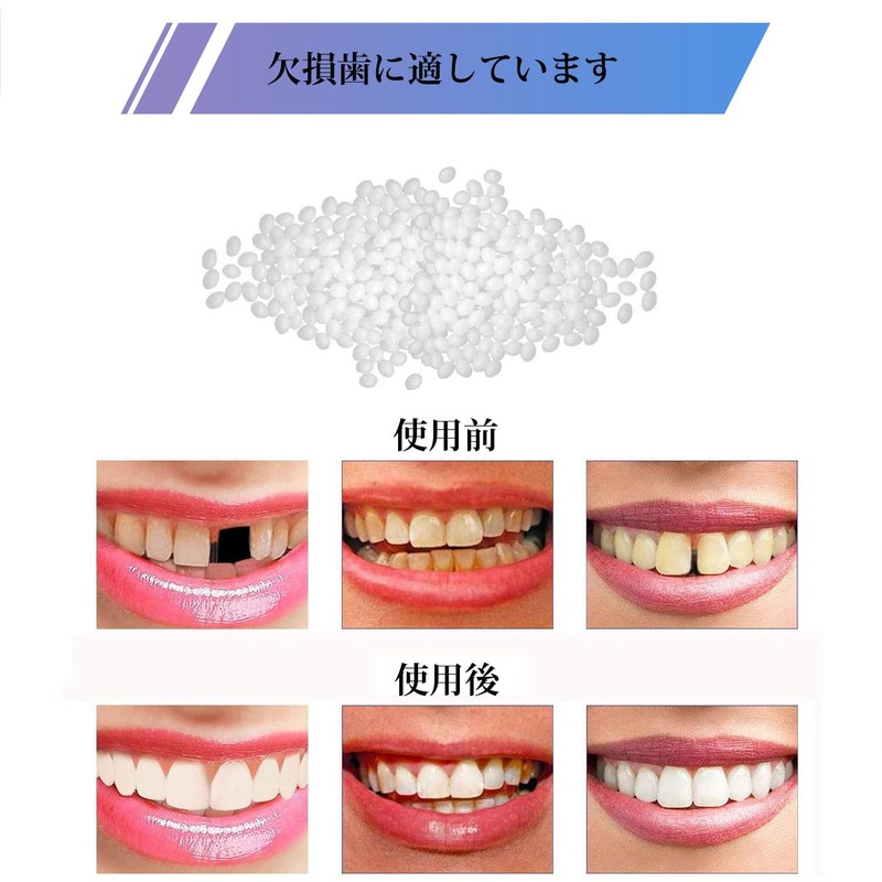 YONGDING Dental Resin Fitting Beads Teeth Repair Kit for Temporary
