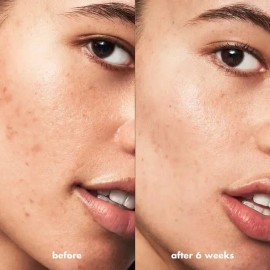 Limpiador Facial Gel E.l.f. Cosmetics Blemish Breakthrou
