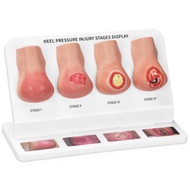 MedEduQuest Heel Pressure Injury Stages Model, Ulcer Demonstration Model