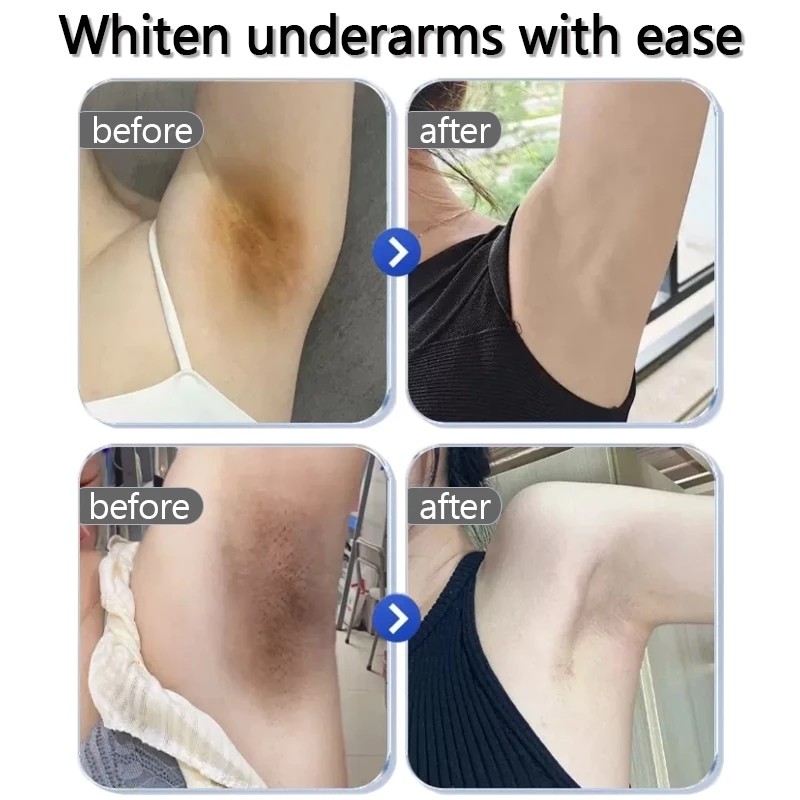 LYDIMOON Underarm melanin removal cream Neck/armpit/elbow/Black acanthoderm precipitation desalination private
