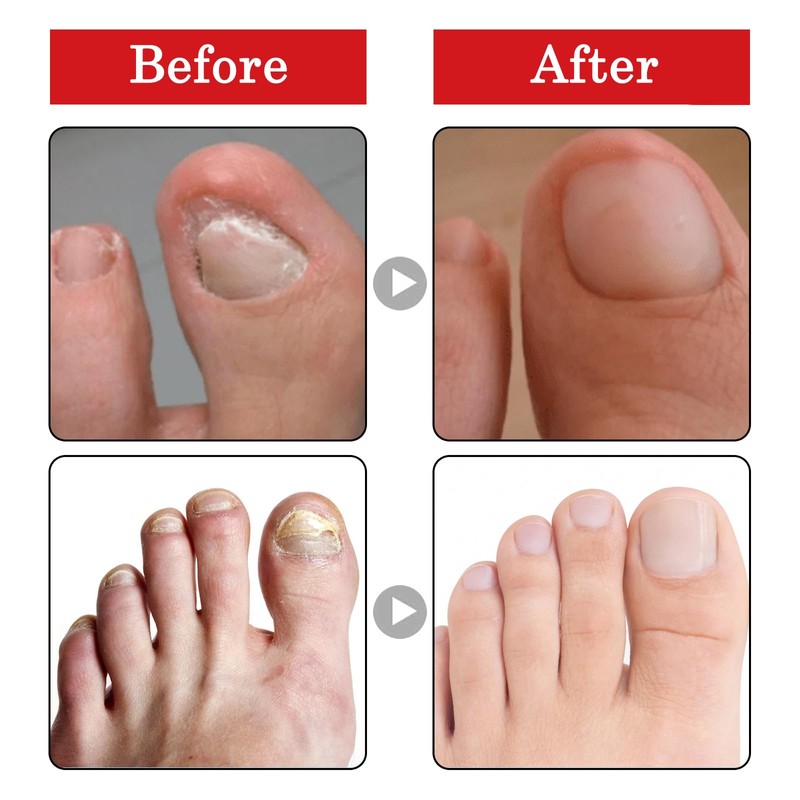 Ingrown Toenail & Cuticle Support Oil – Helps Maintain Nail