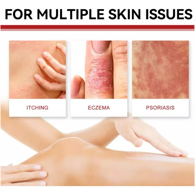 Crema Antibacteriana Psoriasis Eczema Rash Rojo Dermastitis