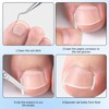 Professional Ingrown Toenail Set Breathable Ingrown Toenail Correction Strips, Curved