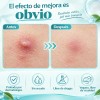 JOVEECO - 720pcs Parches Para Acné Hidrocoloide Absorbe La Grasa,parches