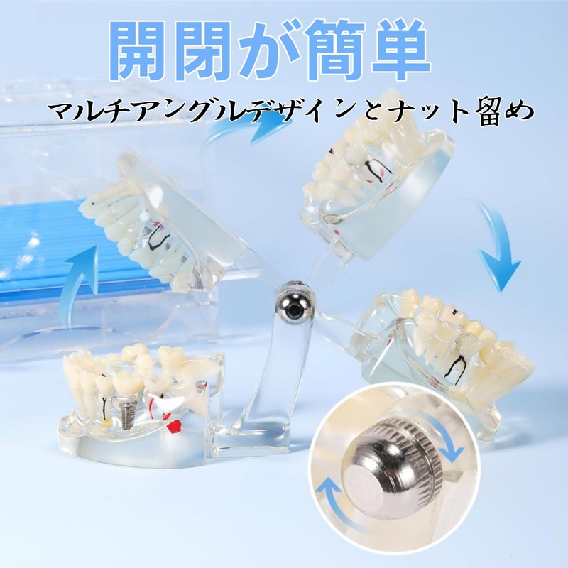 UKYCEORA Transparent Disease Teeth Model, Dental Implant Bridge Dental Teaching