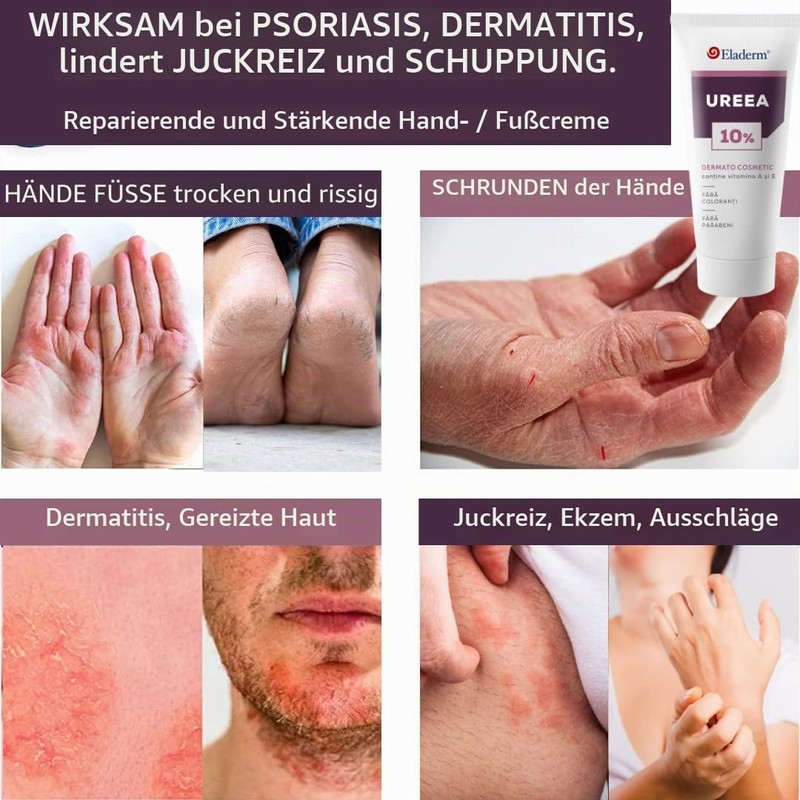 Eladerm Urea Cream 10% 100 ml Urea Cream, Keratosis, Psoriasis,