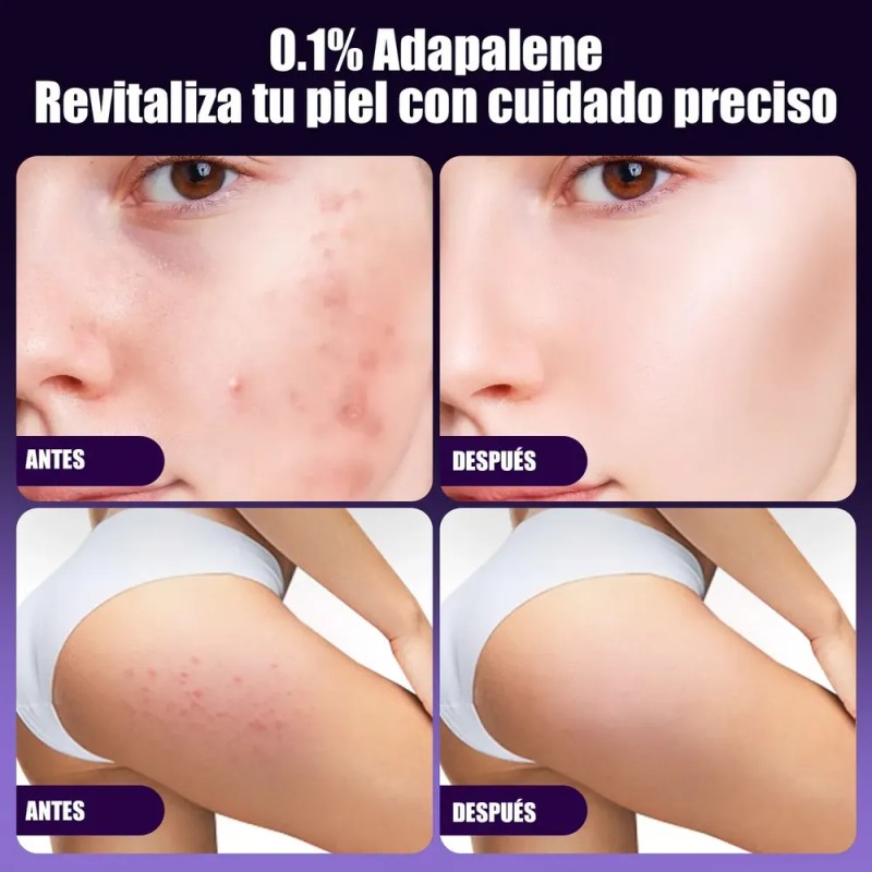 3 Gel Facial Anti-piel Acne Con Adapalene Para Piel Acnes