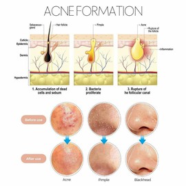 Blackhead Remover Pimple Comedone Extractor Tool Best Acne Removal Kit - Treatment for Blemish, Whitehead Popping, Zit Removing for Risk Free Nose Face Skin (9 Piece Set)