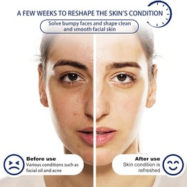 Acne Foaming Wash, Lozione detergente viso e corpo,Schiuma detergente per acne,Detergente viso morbido per la pulizia dei pori profondi