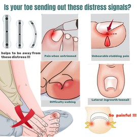 Ingrown Toenail Removal Kit | Titanium Alloy Ingrown Toenail Treatment | Pedicure Tools for Feet, Nail Tools Specially Designed for Curved Nail Repair and Ingrown Toenail Corrector (0.67/0.79in)