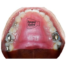RPE Tongue Guard: Prevents and Helps Heal Tongue Sores Caused by Dental Expanders