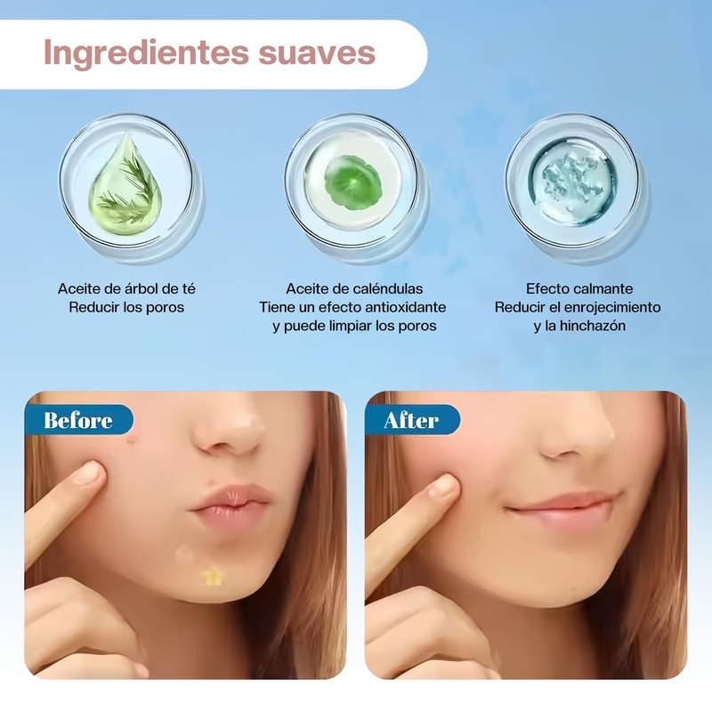 Parches para Acne：200 Piezas Almohadillas Hidrocoloides para Espinillas-Pimple Patch，Parches hidrocoloides