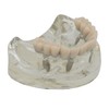 Ningfan Dental Implant Model,Implant All on 4 Overdenture Treatment Model,