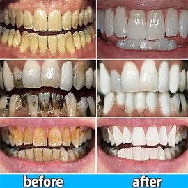 Unbranded Loose Teeth Care Toothpaste Gingivitis Treatment & Cavity Repair Toothpaste US