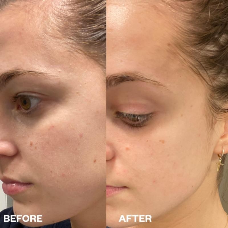 Wrinkles Schminkles Face Polishing Peel Pads - 5 Pack