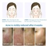 No Brand Real and effective Acne Pimple Cream 祛痘膏祛痘乳霜 20g