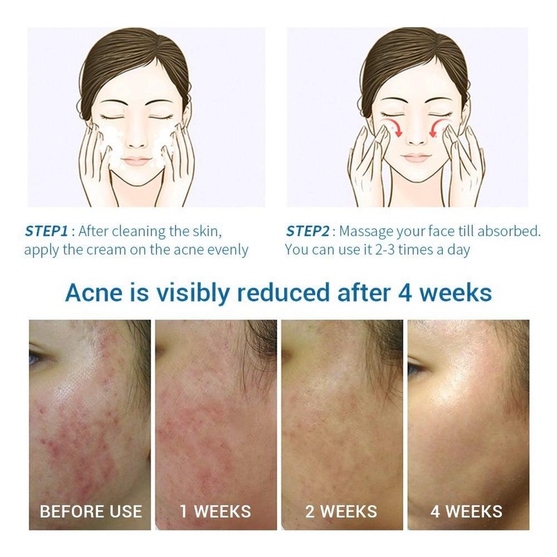 No Brand Real and effective Acne Pimple Cream 祛痘膏祛痘乳霜 20g