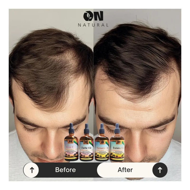 Aceite Cúrcuma Natural Para Cabello Sano Y Cuero Cabelludo 1