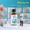 Líquido Para Verrugas 30 Ml - Eliminación Rápida
