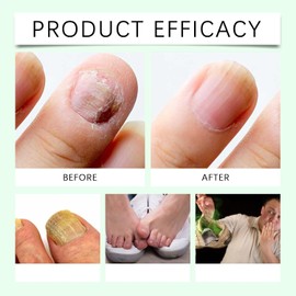 7 días de cuidado líquido de uñas jengibre árbol té, cuidado líquido uñas, cutículas uñ/as dañadas, hidratados, regenera uñ/as que rompen fácilmente, gotas soporte aplicables para uñas pies. (2pcs)