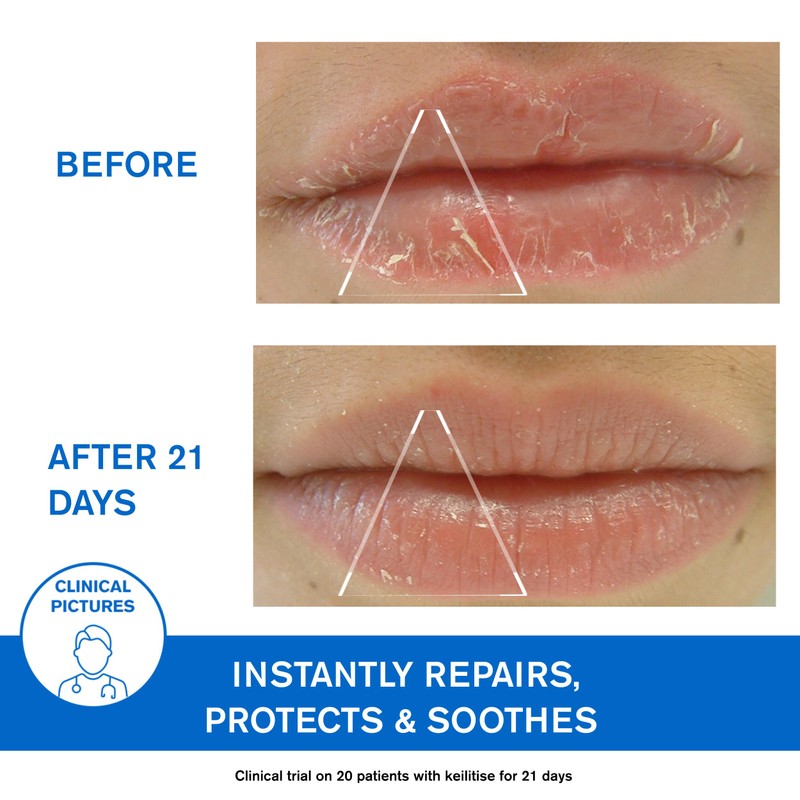 Uriage Uriage Bariederm Cica-lips Protecting Balm 0.5 Oz.