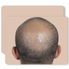 3PCS/Pack Scalp Micropigmentation Practice Skin – Printed SMP Tattoo Training