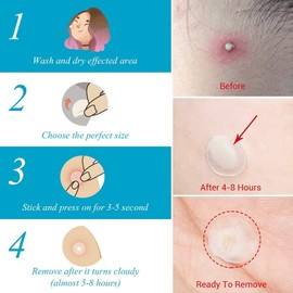 Lanbena Parches Anti Acne, Tratamiento Completo Día Y Noche, contiene 53 parches para absorber el acné, aplanando y calmando la piel.