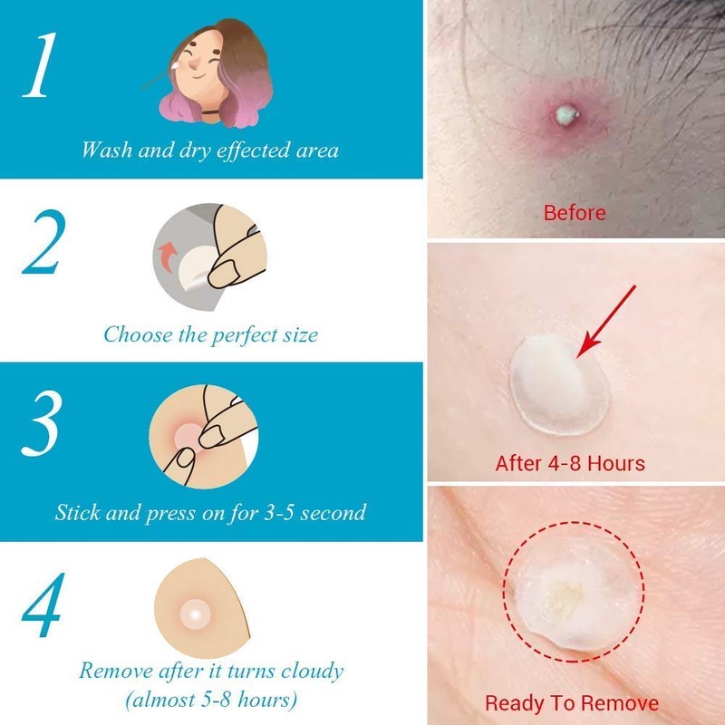 Lanbena Parches Anti Acne, Tratamiento Completo Día Y Noche, contiene