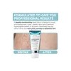 Tratamiento Para La Queratosis Pilaris | Loción Para La Quer