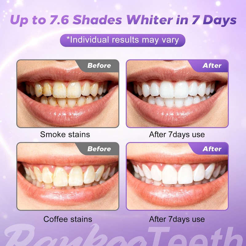 Teeth Whitening Strips Purple 28 Strips - Gentle & Effective