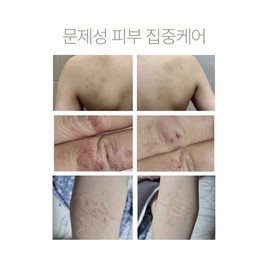 Itchy Ato skin trouble 3-day deleted shot PDRN Ato Shot - 2 PDRN Ato Shots / 가려운 아토 피부 트러블 3일 삭제샷 PDRN 아토샷 - PDRN아토샷 2개