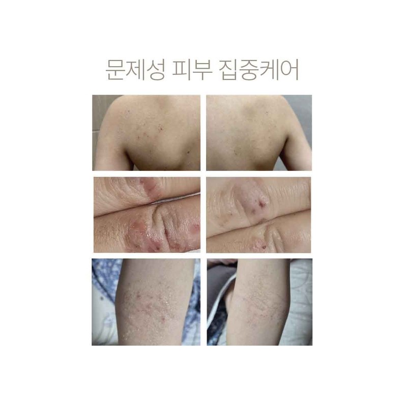 Itchy Ato skin trouble 3-day deleted shot PDRN Ato Shot
