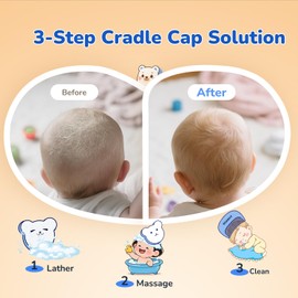 Wishbird Cloud 3-in-1 Cradle Cap Care Kit for Babies – Soft Bristle Scalp Brush, Gentle Comb & 2 Sponges, Safe for Newborns, BPA-Free, Easy to Use, Cradle Cap Remover Kit, Serene Green