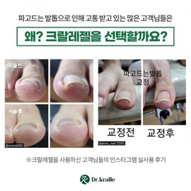Dr. Cralle Krale Gel Mini 3-piece set 6ml Ingrown toenail nail pedicure resin gel C-curve nail Dr. Krale gel 3-piece set / 닥터크랄레 크랄레젤 미니3종 세트 6ml 파고드는발톱 손톱 페디케어 레진젤 C커브손발톱 닥터크랄레젤 3종세트