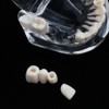 Detachable Dental Model Dental Disease Teaching Study Typodont Demonstration Tooth