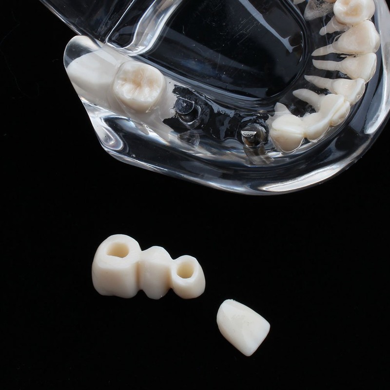 Detachable Dental Model Dental Disease Teaching Study Typodont Demonstration Tooth