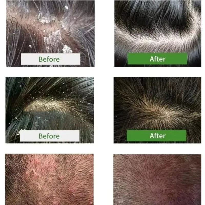 BONITA ORGANICS Shampoo Alquitran De Hulla Control Psoriasis, Caspa 2