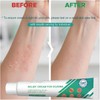 Eczema Cream Anti Itch Cream Maximum Strength