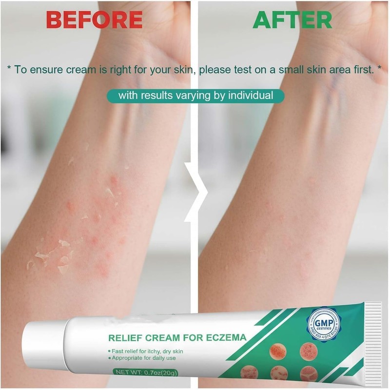 Eczema Cream Anti Itch Cream Maximum Strength